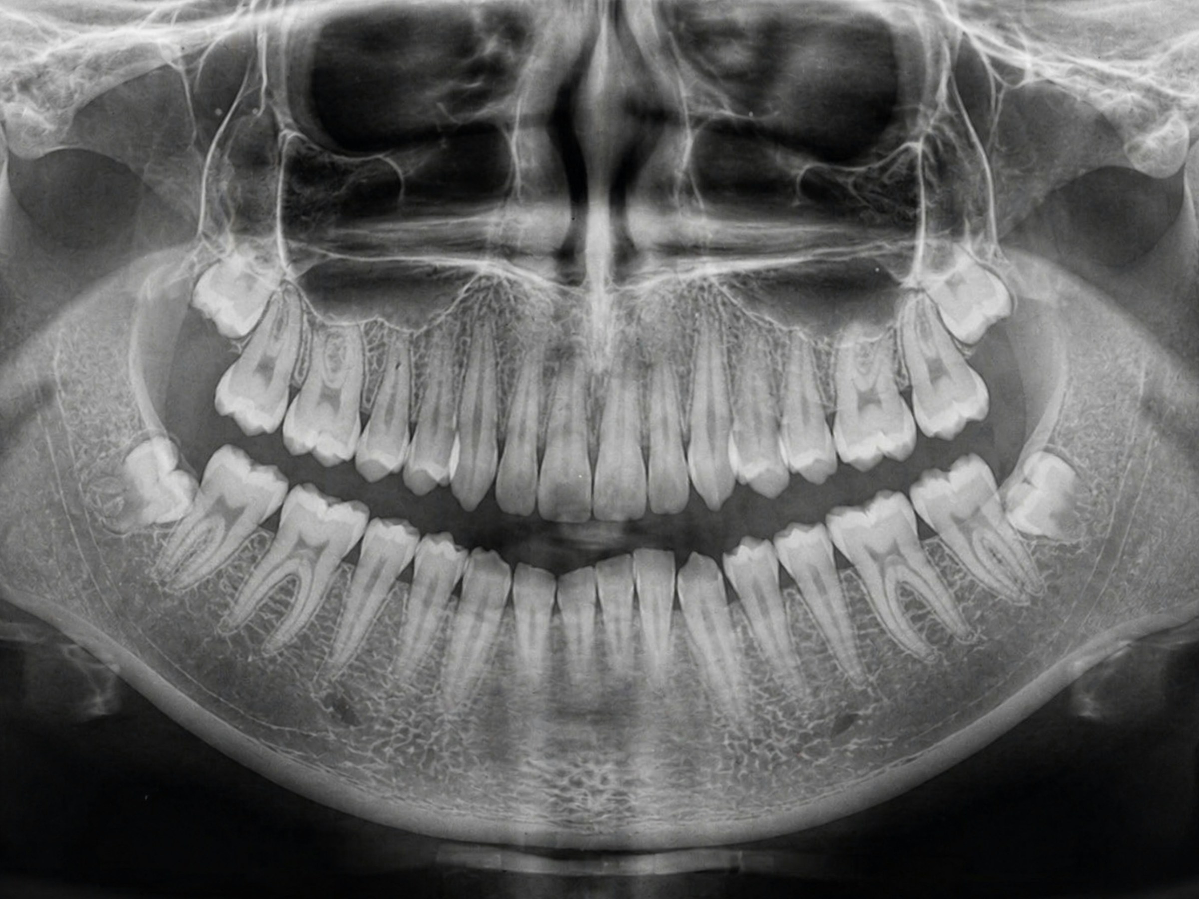 Panoramic dental radiograph