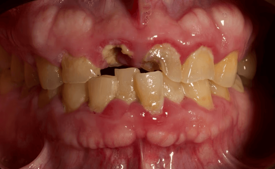 Before: worn and fractured anterior teeth