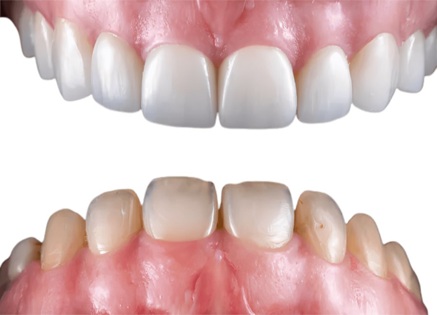 Before and after smile comparison