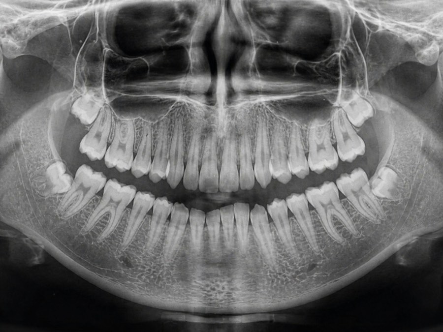 Panoramic dental radiograph