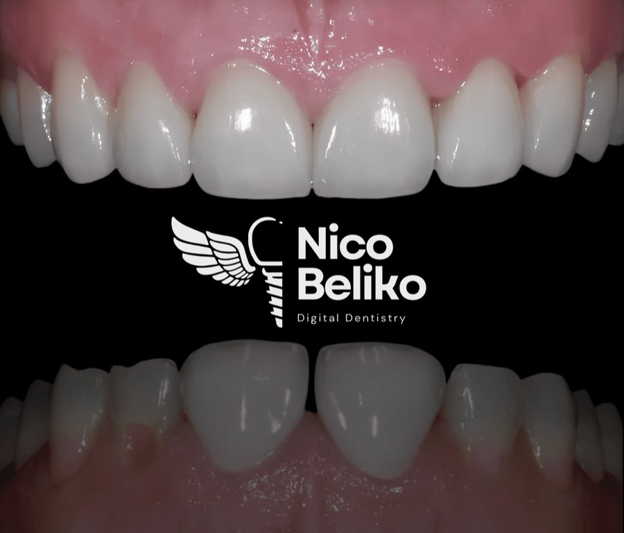 Milled zirconia crowns on a model